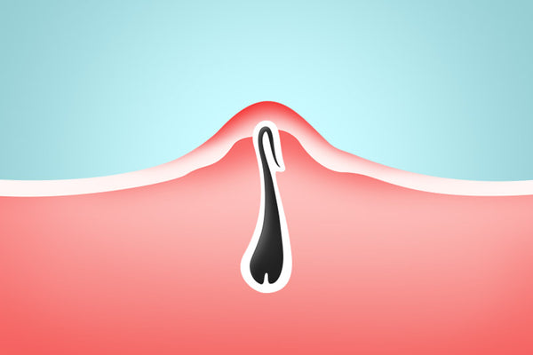 Dos and Donts For Handling Your Ingrown Hairs